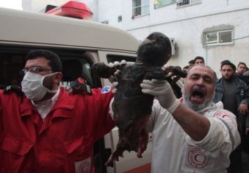 Palestinian child burned by the Israel Defense Force in Gaza
